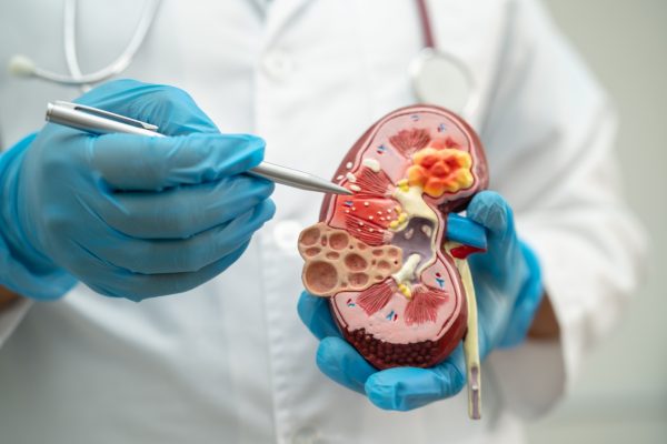 A-brief-overview-of-kidney-disease Kidney disease, Chronic kidney disease ckd, Doctor hold model to study and treat in hospital.